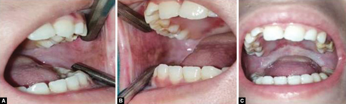 对于槟榔造成的口腔危害,首先是去除致病因素,戒掉咀嚼槟榔的习惯